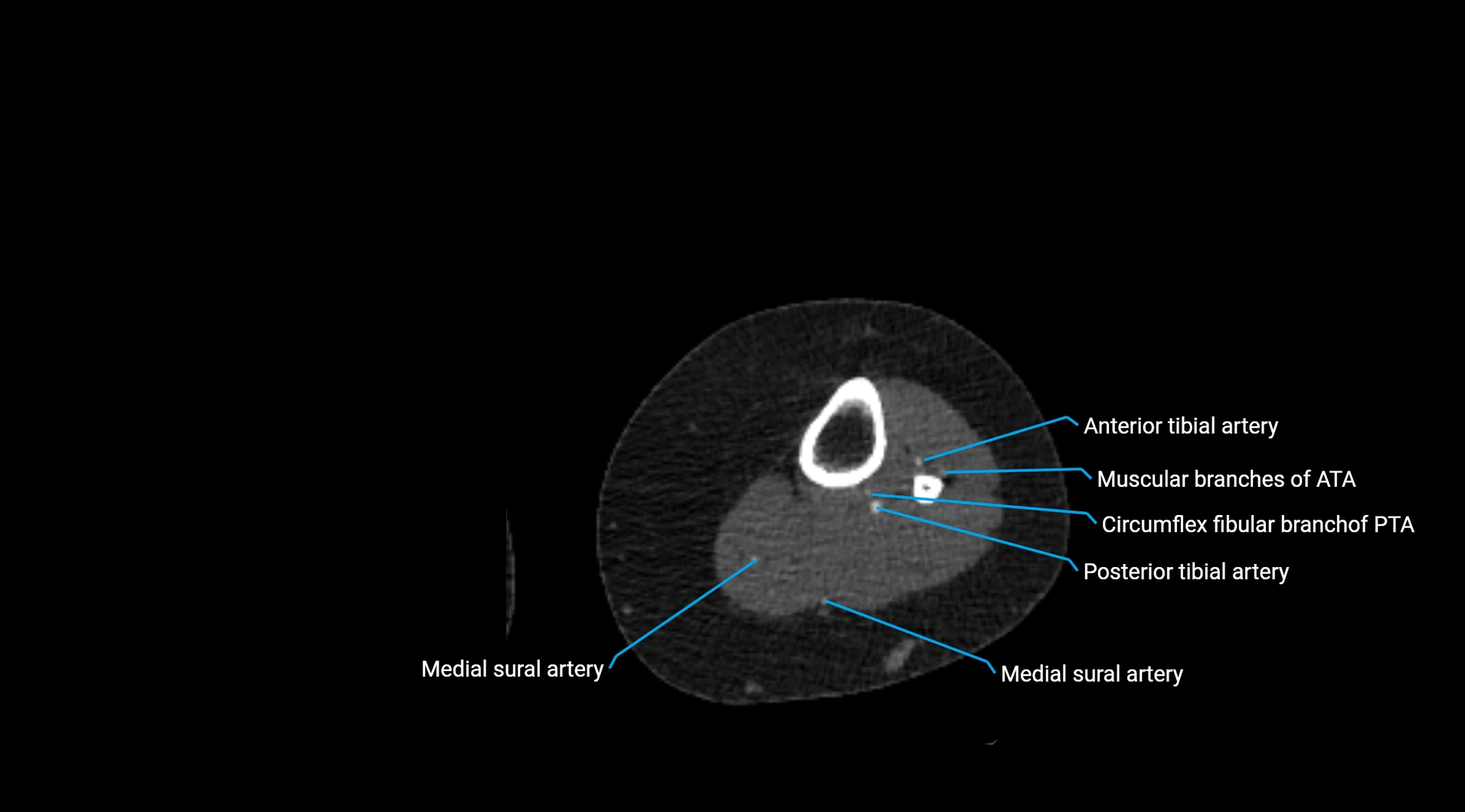 CTA lower limb cross sectional anatomy labelled image _195.webp